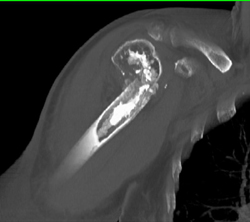 Fracture With Chondroma - CTisus CT Scan