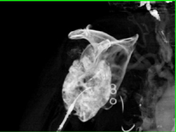 Chondrosarcoma - CTisus CT Scan