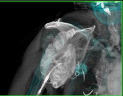 Chondrosarcoma - CTisus CT Scan