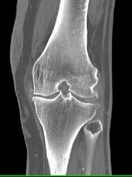 Calcified Meniscus - CTisus CT Scan