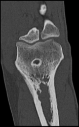 Remodeling of Bone - CTisus CT Scan