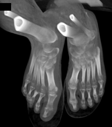 Osteomyelitis of First Digit - CTisus CT Scan