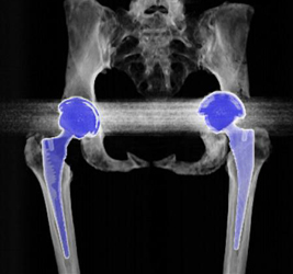 Total Hip Replacements (THRs) - CTisus CT Scan