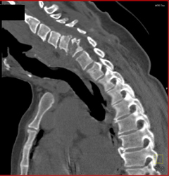 Metastasis From Renal Cell Carcinoma - CTisus CT Scan