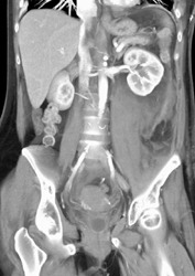 Psoas Bleed S/P Trauma With Spinal Fractures - CTisus CT Scan