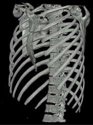 Pectus Deformity - CTisus CT Scan