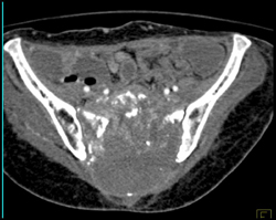 Chordoma - CTisus CT Scan