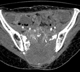 Chordoma - CTisus CT Scan