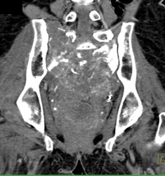 Chordoma - CTisus CT Scan