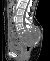 Chordoma - CTisus CT Scan