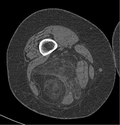 Liposarcoma - CTisus CT Scan