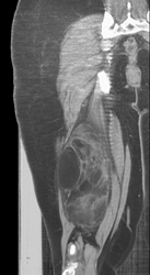 Liposarcoma - CTisus CT Scan