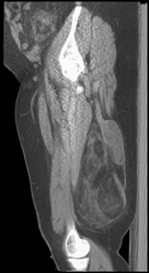 Liposarcoma - CTisus CT Scan