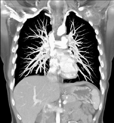 Abscess to Left Supraclavicular Zone With Pseudoaneurysm (hx-IVDA) - CTisus CT Scan