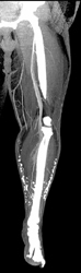 Vascular and Soft Tissue Calcification - CTisus CT Scan