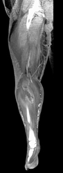 Abscess in Gastrocnemius Muscle - CTisus CT Scan