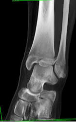 Tibial Fracture - CTisus CT Scan