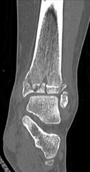 Spiral Fracturewith Fracture Line Through Epiphysis - CTisus CT Scan