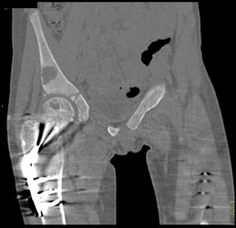 Cystic Lesion-probably Benign - CTisus CT Scan