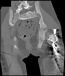 Post Open Reduction Internal Fixation (ORIF) for CHD - CTisus CT Scan