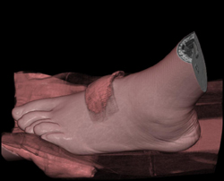 Abscess - CTisus CT Scan