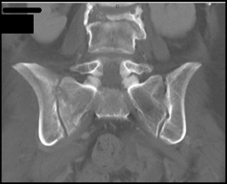 Right SI Joint Infection - CTisus CT Scan