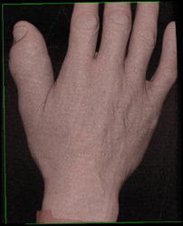 Osteomyelitis - CTisus CT Scan