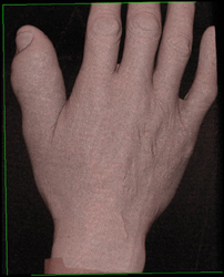 Osteomyelitis - CTisus CT Scan