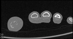 Osteomyelitis - CTisus CT Scan