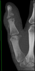 Osteomyelitis - CTisus CT Scan