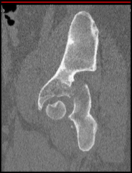 Posterior Acetabular Fracture With Bone Editing and Disarticulation - CTisus CT Scan