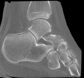 Multiple Fractures Including Talus Fracture - CTisus CT Scan