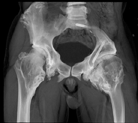 Multiple Hereditary Exostosis - CTisus CT Scan