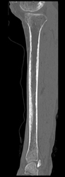 Stress Fracture - CTisus CT Scan