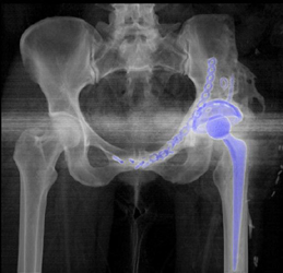 Slipped Acetabular Cup - CTisus CT Scan