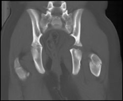 Fracture in Left Acetabulum - CTisus CT Scan