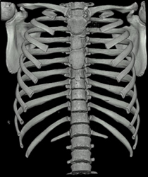 Pectus Deformity - CTisus CT Scan