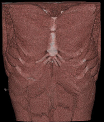 Pectus Deformity - CTisus CT Scan