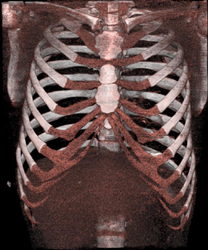 Pectus Deformity - CTisus CT Scan