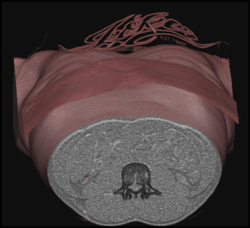 Pectus Deformity - CTisus CT Scan