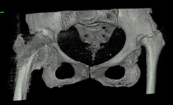 Congenital Hip Dislocation With Pseudo-acetabulum - CTisus CT Scan