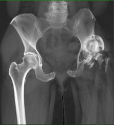 Dislocated Hip - CTisus CT Scan