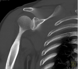 Humerus Fracture - CTisus CT Scan