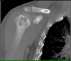 Humerus Fracture - CTisus CT Scan