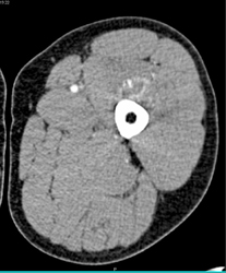 Bleed in Hemophiliac With Prior Calcification - CTisus CT Scan