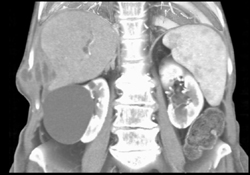 Recurrent Abdominal Wall Implants - CTisus CT Scan