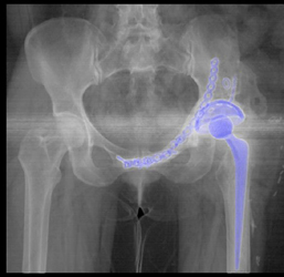 Post Processing of Total Hip Replacement (THR) - CTisus CT Scan