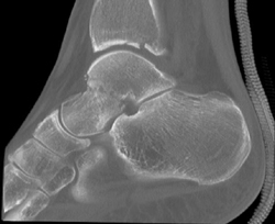 Tibial Fracture - CTisus CT Scan