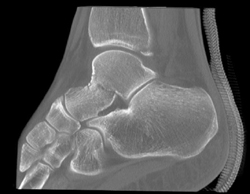 Tibial Fracture - CTisus CT Scan