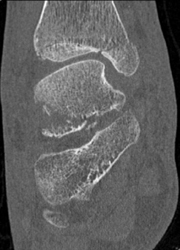 Talus Fracture - CTisus CT Scan